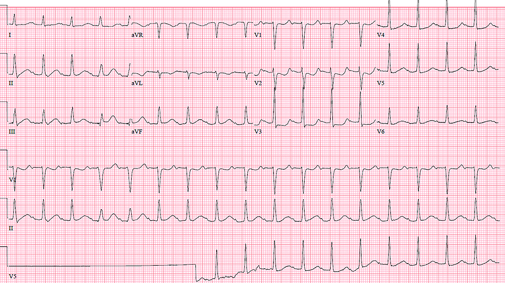 Cureus | Recurrent ST Elevation Myocardial Infarction from ...