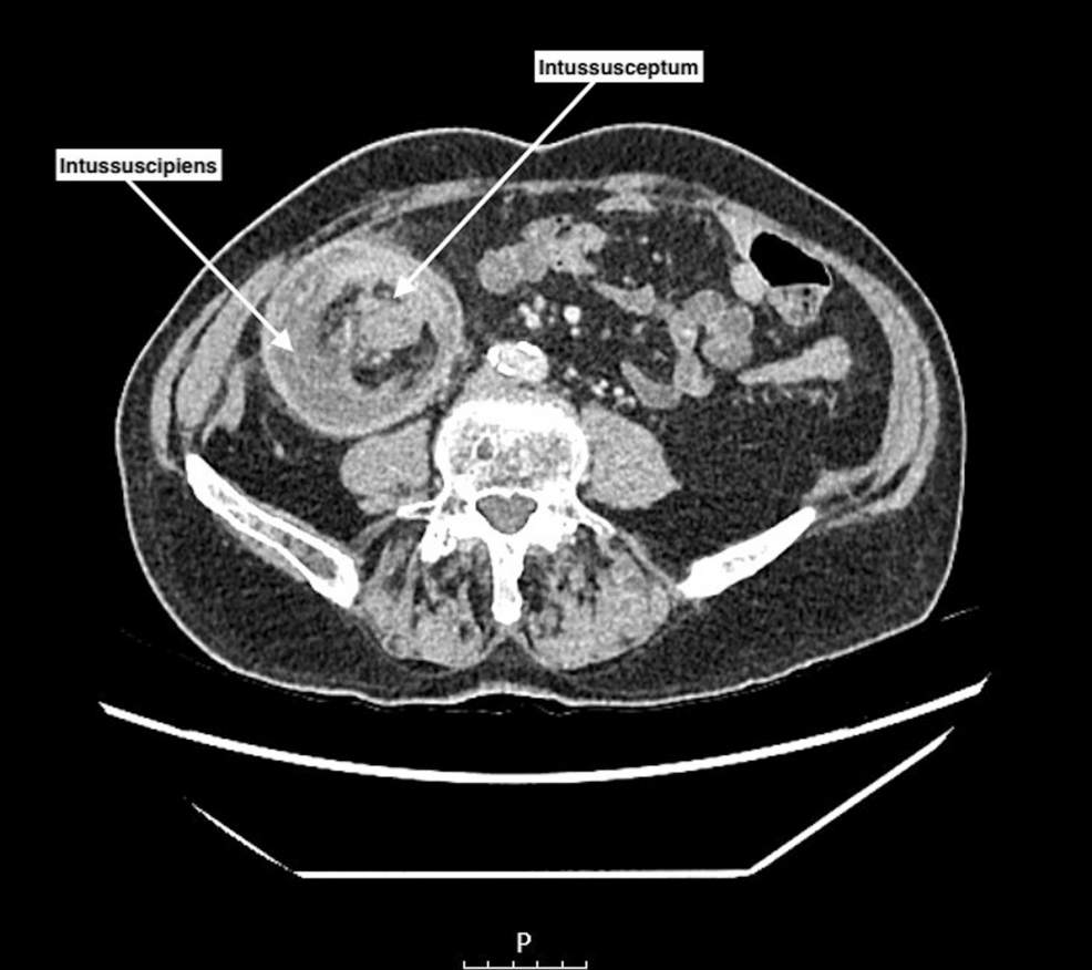 The Importance of Abdominal Pain in the Elderly: An Unlikely Diagnosis of  17 cm Colo-Colonic Intussusception | Cureus