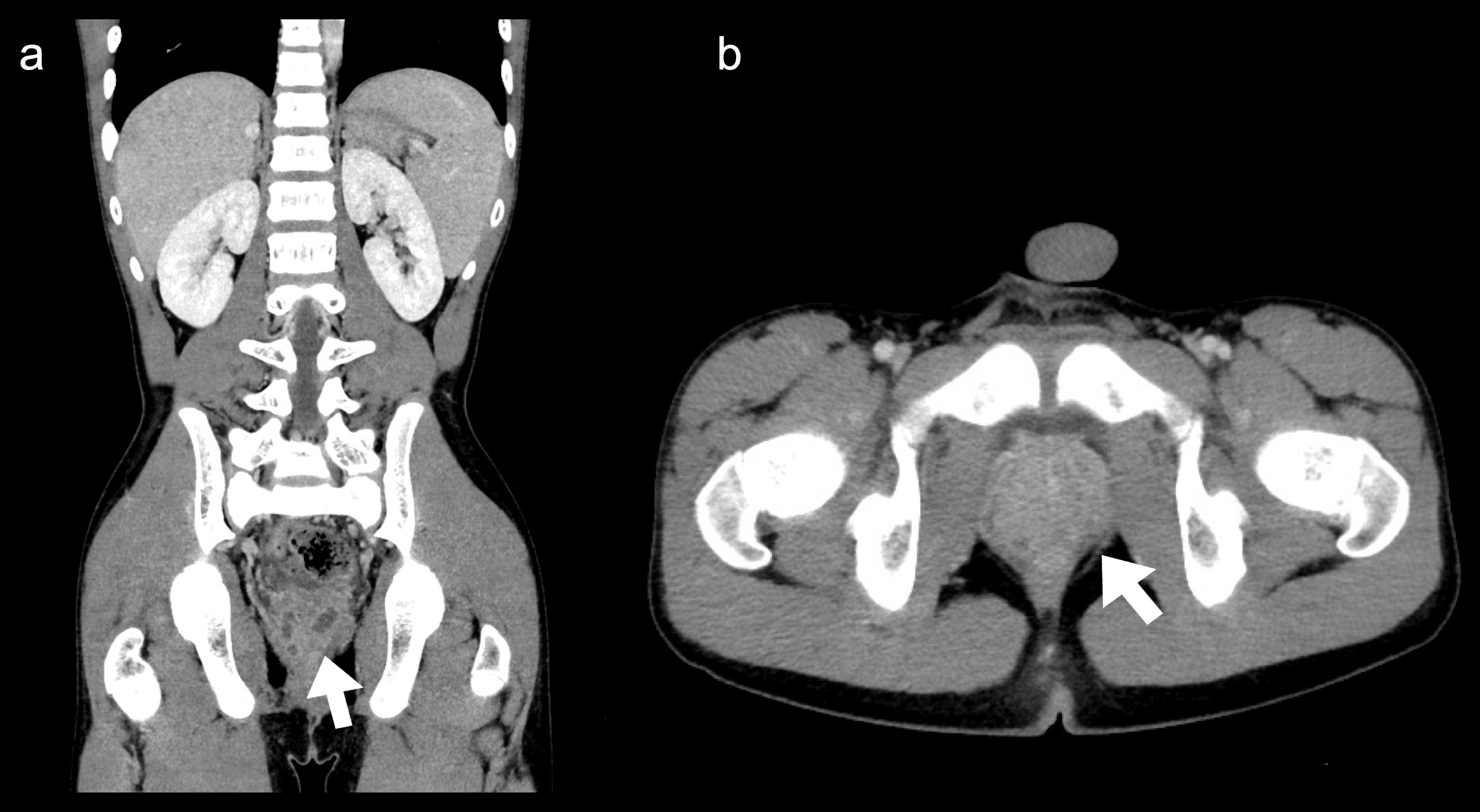 Cureus Acute Bacterial Prostatitis In A 12 Year Old Boy Without Any cureus-acute-bacterial-prostatitis-in-a-12-year-old-boy-without-any
