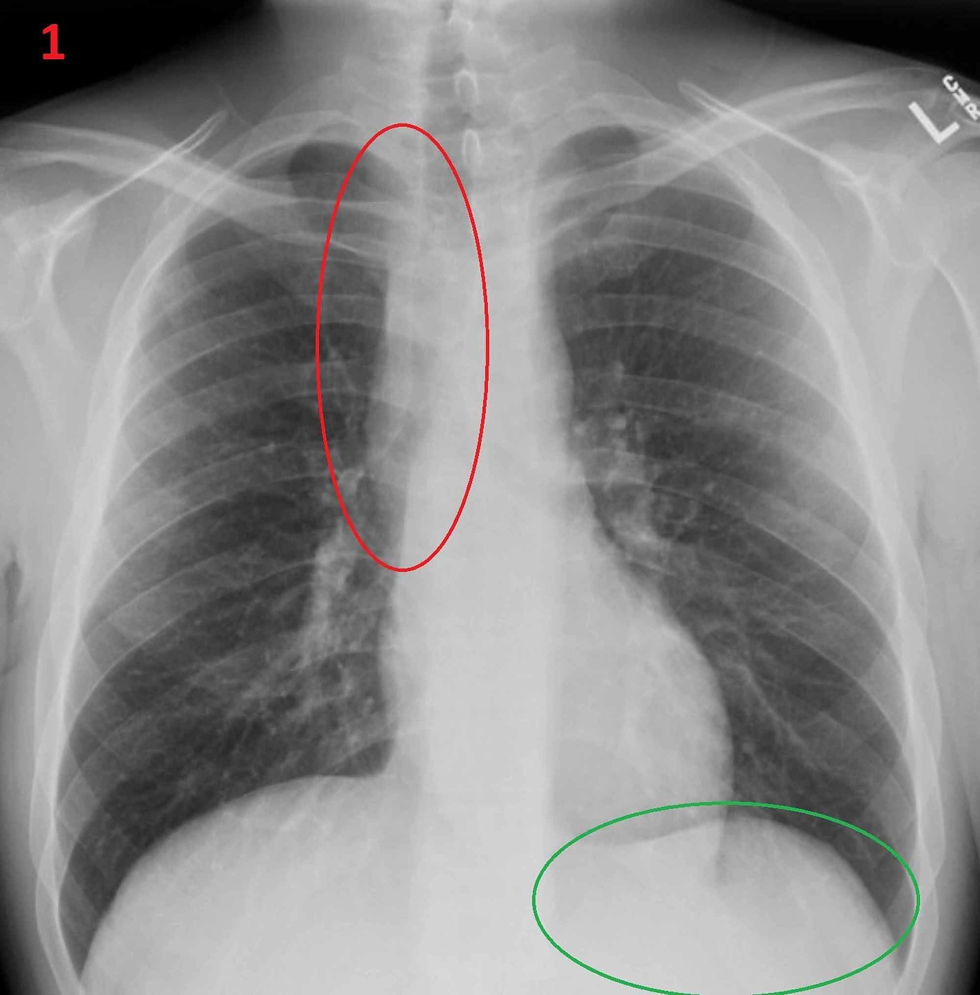 syncopal episode icd 9