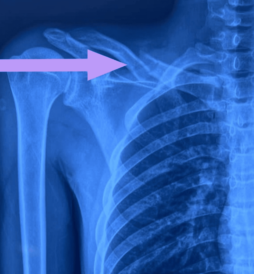 Xray Image Of Shoulder Stock Photo - Download Image Now - Anatomy, Clavicle,  Data - iStock, image size:986x1065
