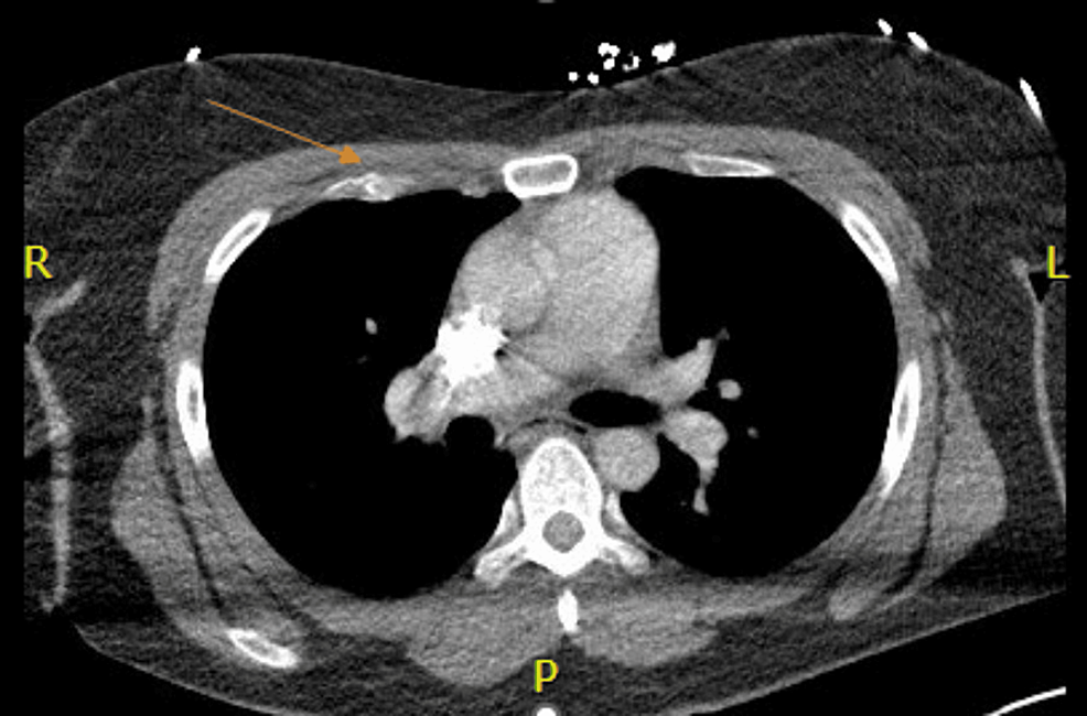 CT-axial-scan-of-the-chest-with-intravenous-contrast---image-1