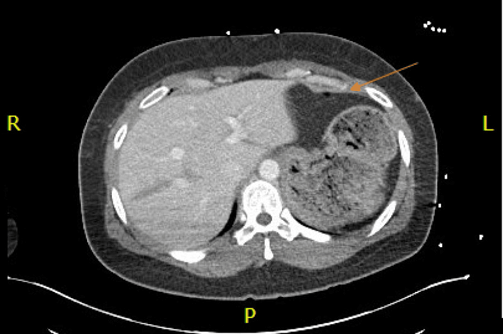 CT-axial-scan-of-the-chest-with-intravenous-contrast---image-2