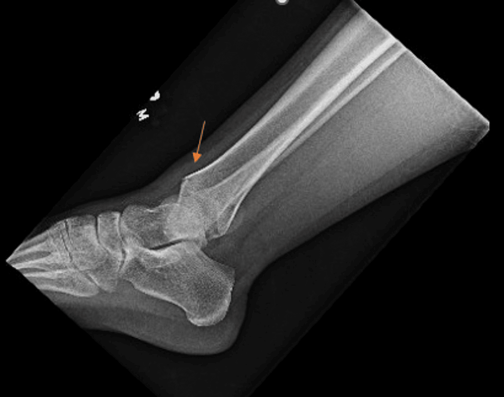 Lateral-radiograph-of-the-ankle-X-ray-series