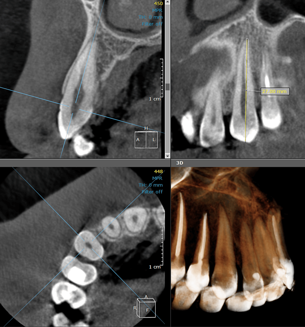 The Accuracy of Cone Beam Computed Tomography Scans in