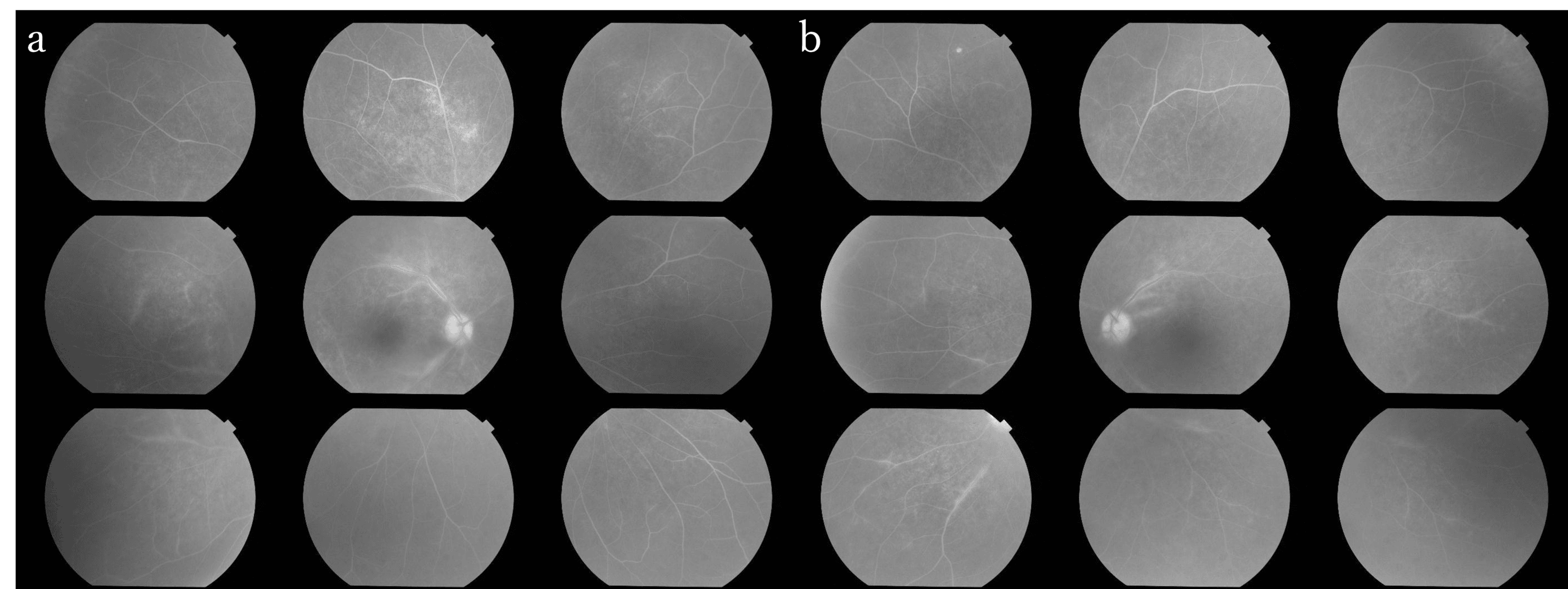 syphilitic-uveitis-with-diverse-clinical-presentations-multimodal