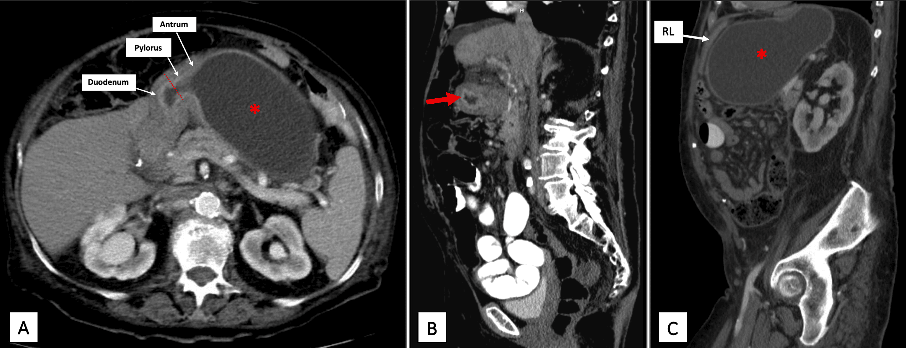 Laparoscopy With Percutaneous Transgastric Endoscopy for the Assessment