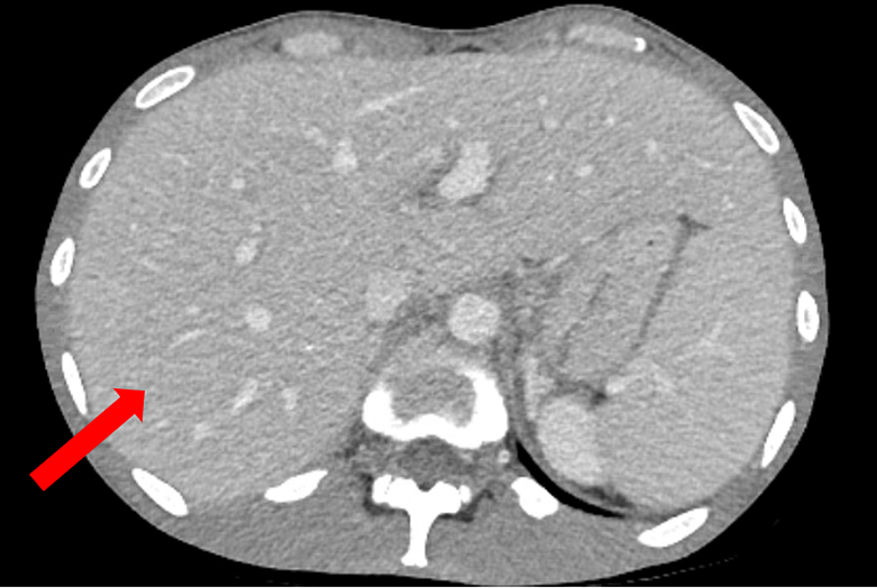 CT de l'abdomen avec contraste IV