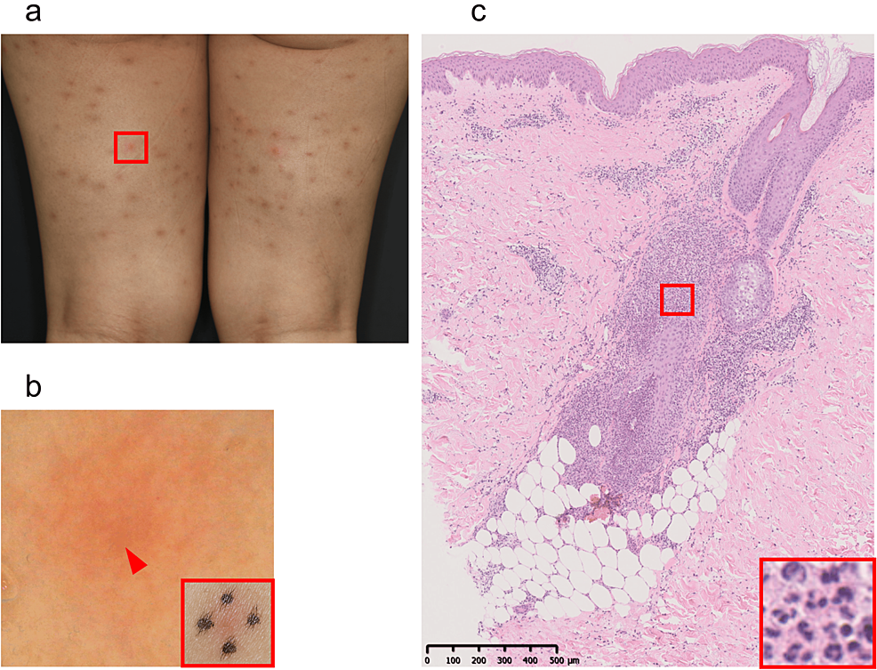 Acneiform Eruptions Possibly Triggered by Clarithromycin During