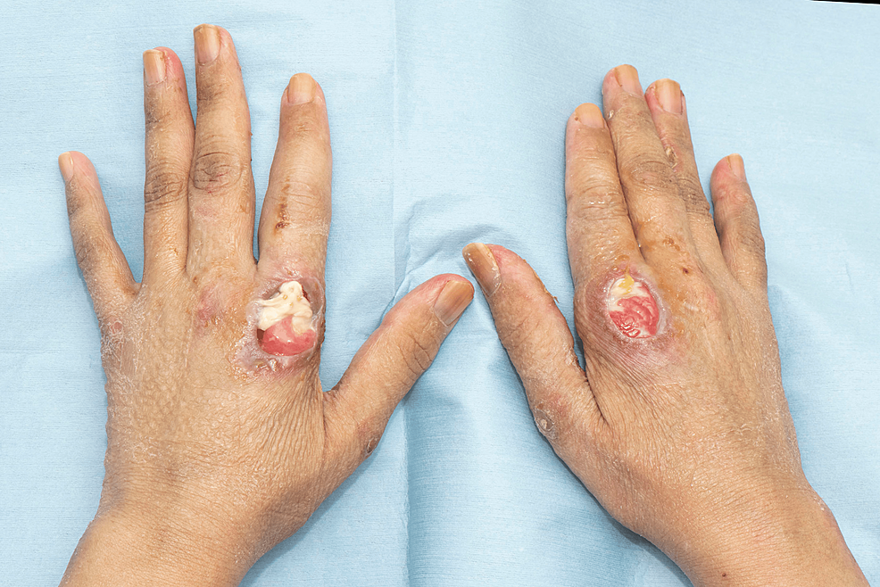 Ulcerated-Gottron's-papule-on-the-MCP-joints-of-the-index-fingers-of-patient-1