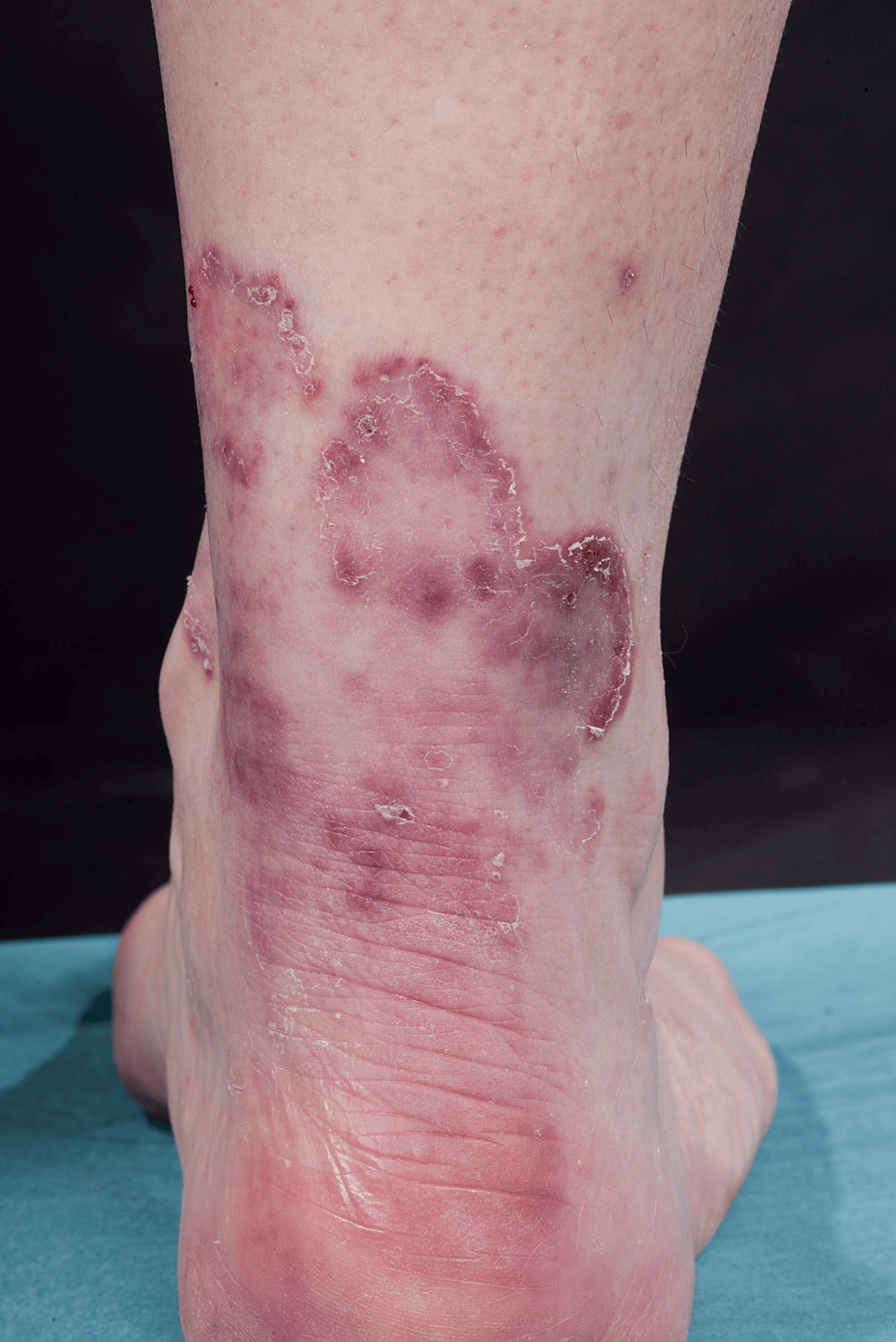 Multiple-arcuate-erythematous-plaques-with-marginal-scaling-on-the-right-lower-leg-of-patient-2