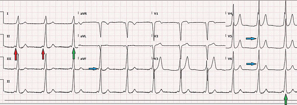 wpw syndrome delta wave