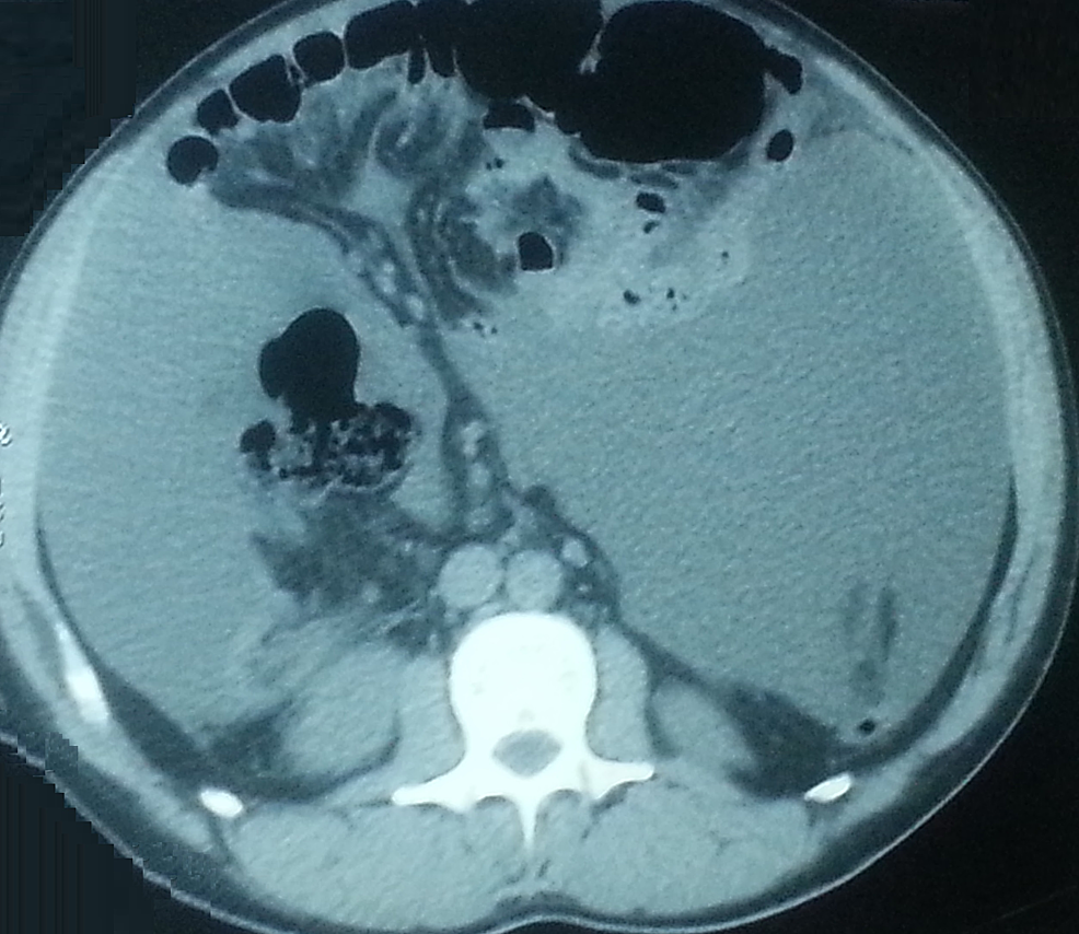 Peritoneal-effusion-with-micronodular-peritoneal-implants-in-abdominal-computed-tomography.