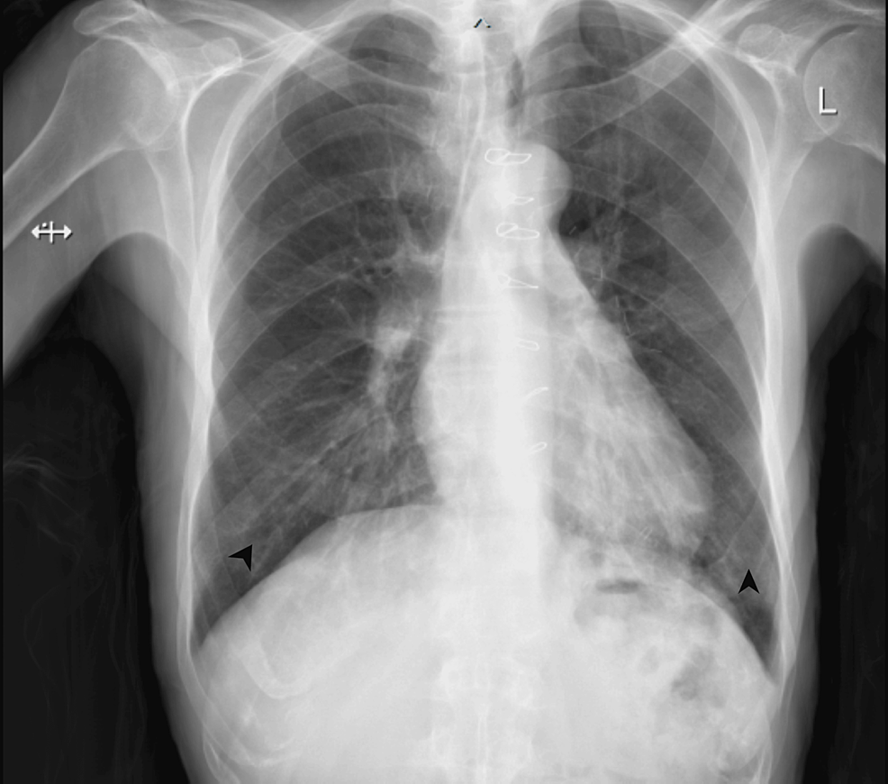 Chest-X-ray-upon-presentation-showing-bilateral-lower-zones-infiltrate-indicated-by-the-arrows.