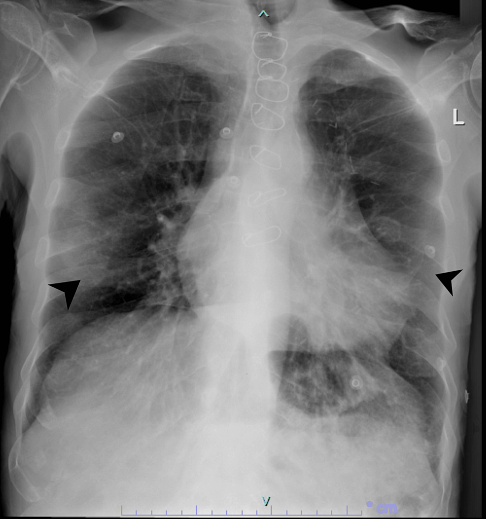 Chest-X-ray-after-two-days-revealing-more-obvious-bilateral-peripheral-infiltrates-indicated-by-the-arrows,-characteristic-of-Covid-19-pneumonia.