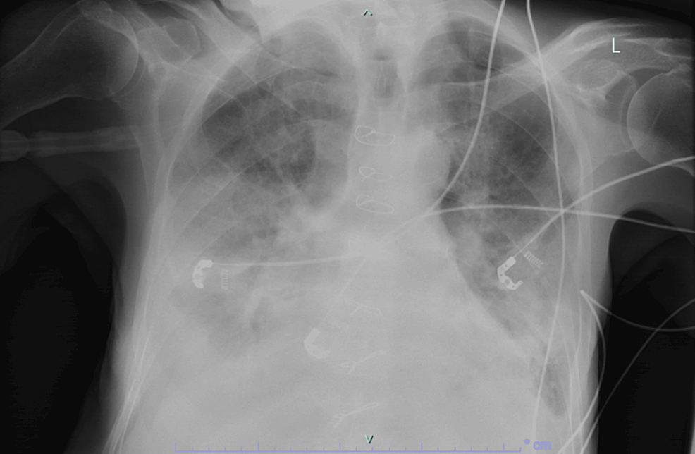 A-few-days-later,-chest-X-ray-deteriorated-and-continued-to-deteriorate-after-until-he-passed-away,-unfortunately.