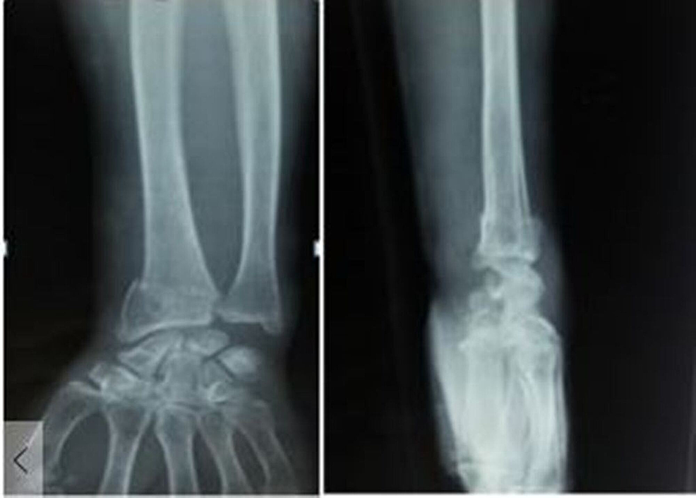 Radiographs-anteroposterior-and-lateral-view-showing-fracture-of-distal-radius