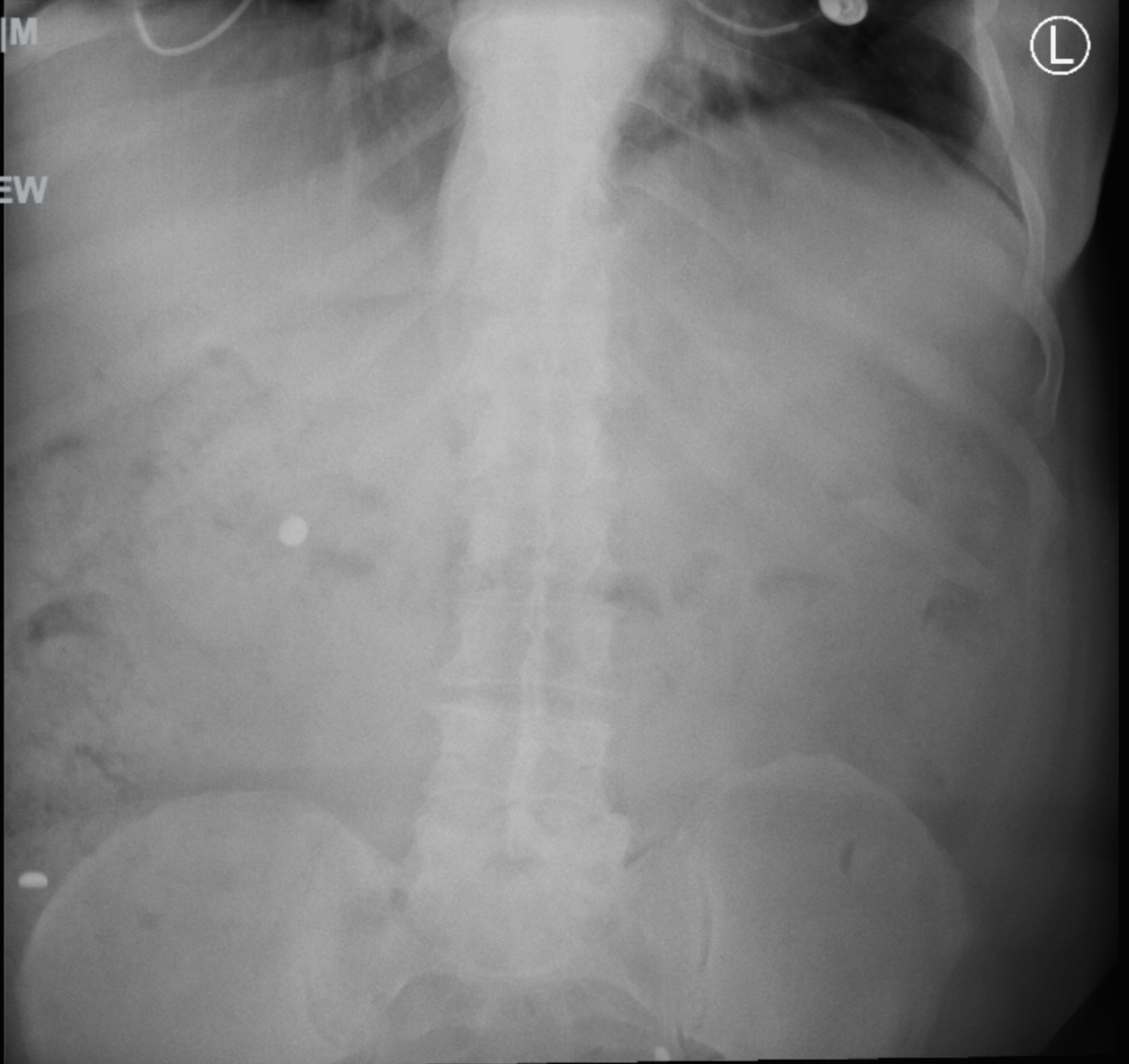 Ingestion of 14 Hearing Aid Batteries in an Adult Patient Cureus