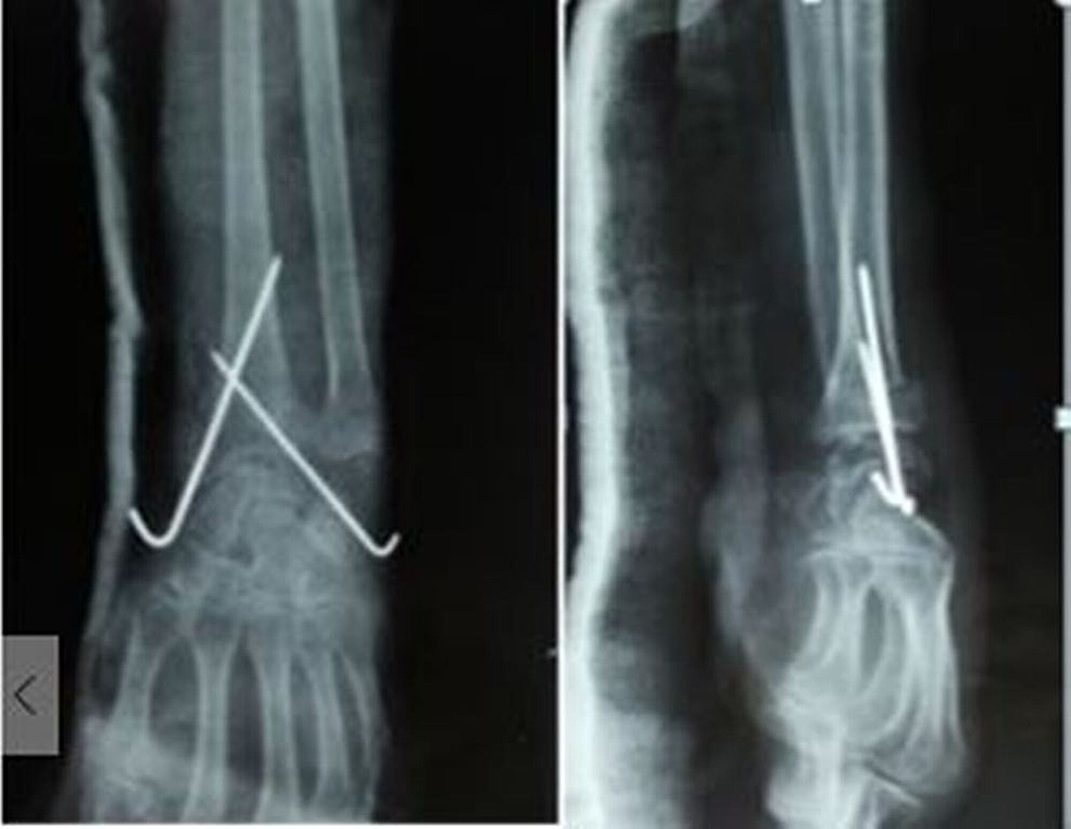 Post-reduction-anteroposterior-and-lateral-radiographs-showing-good-reduction