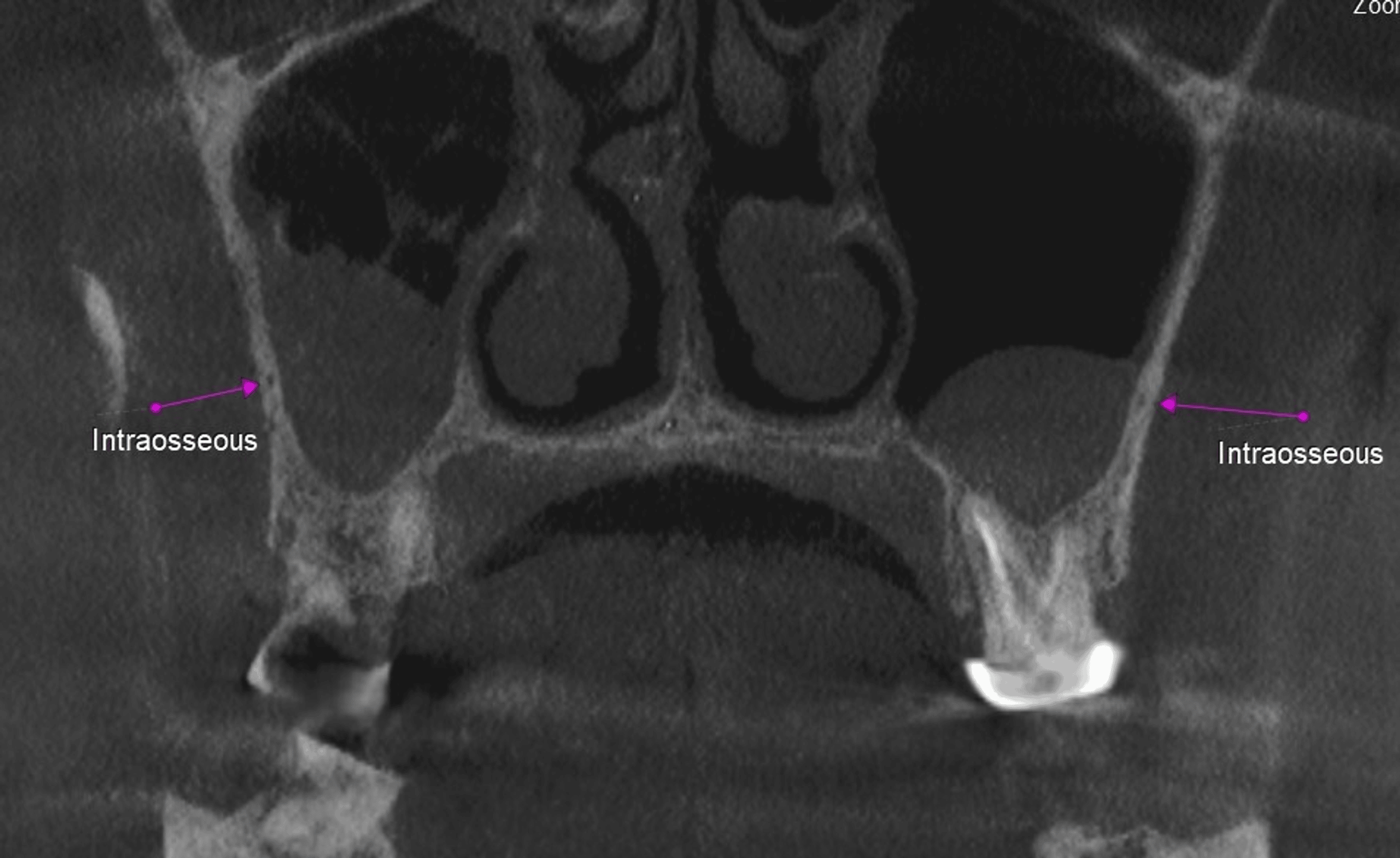 Prevalence, Location, and Variations of the Posterior Superior Alveolar ...