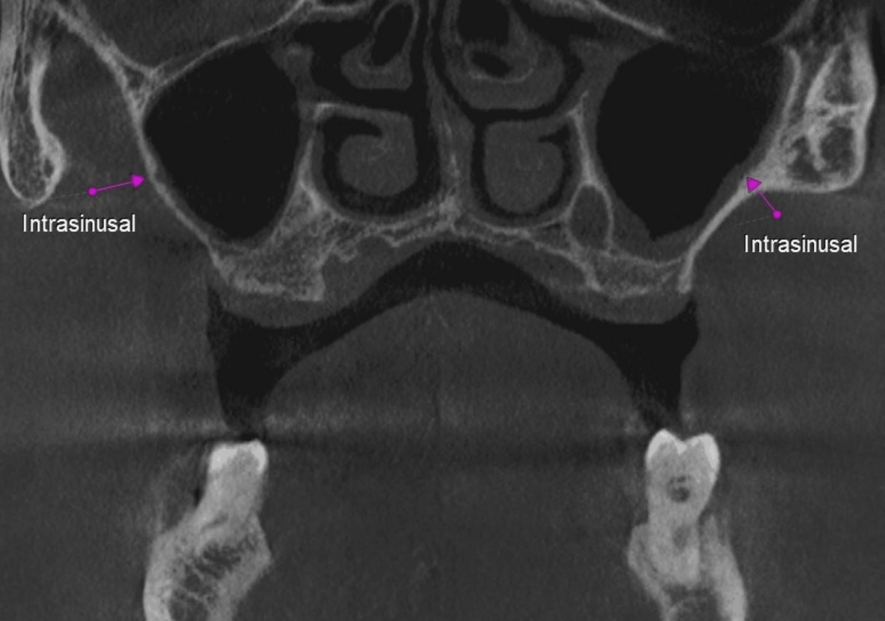 Prevalence, Location, and Variations of the Posterior Superior Alveolar ...