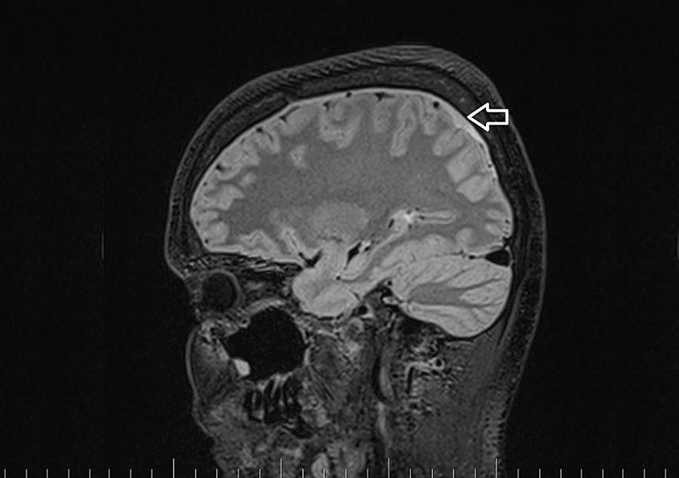 Brain-MRI-on-March-5,-2023. Brain-MRI-on-March-5,-2023.