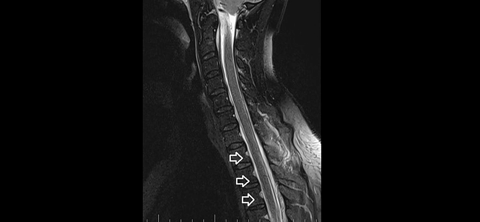 C-spine-MRI-on-March-5,-2023. C-spine-MRI-on-March-5,-2023.