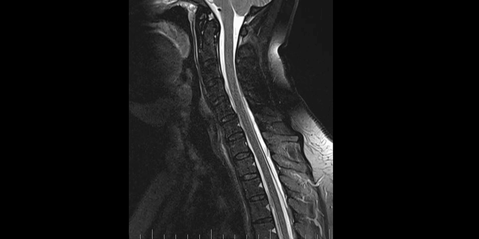 C-spine-MRI-on-September-4,-2023. C-spine-MRI-on-September-4,-2023.