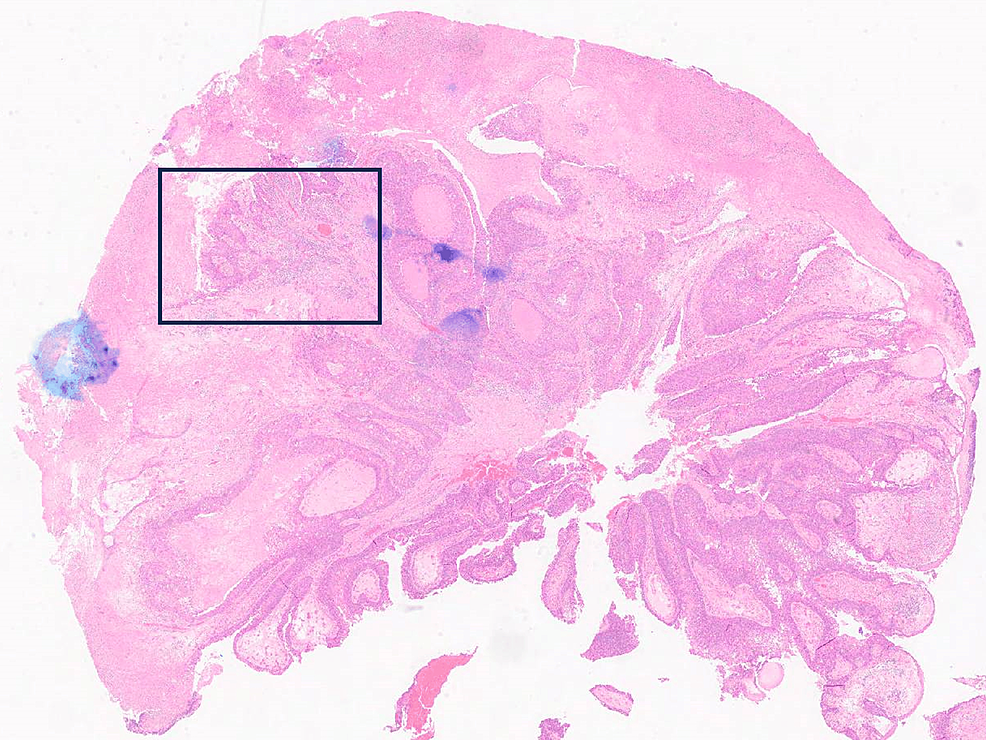 Cureus Primary Invasive Pagets Disease In A Clinical Practice A