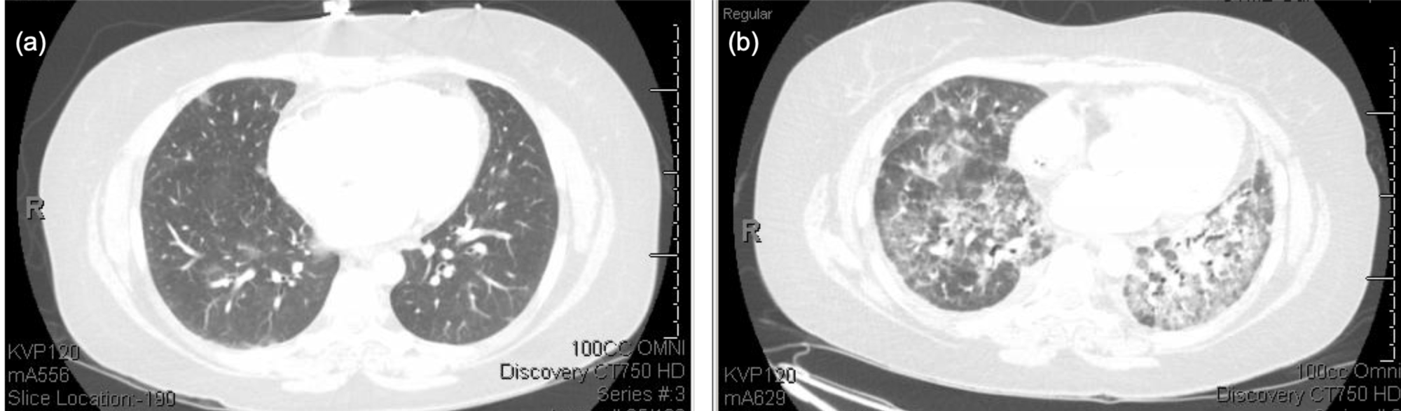 Cureus | Oxaliplatin-induced Pulmonary Toxicity: A Rare but Serious ...