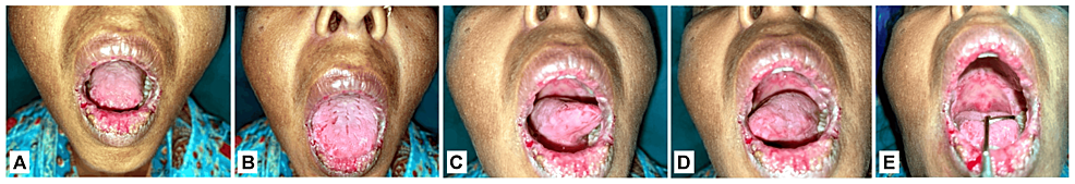 Herpes Simplex Virus (HSV)-Induced Erythema Multiforme: A Rare Case Report 
