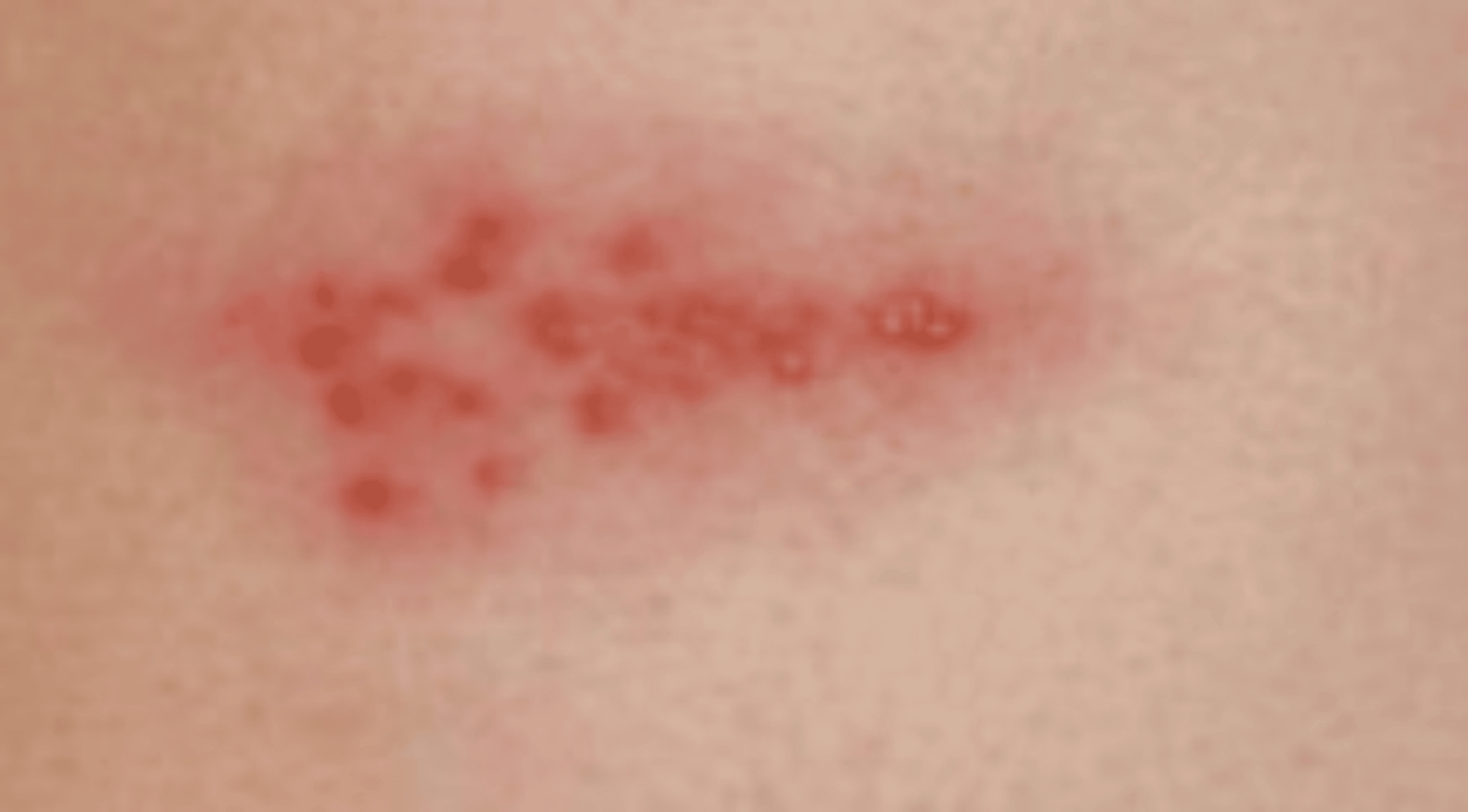 Herpes Zoster in a 13YearOld Male Without Prior Varicella Infection