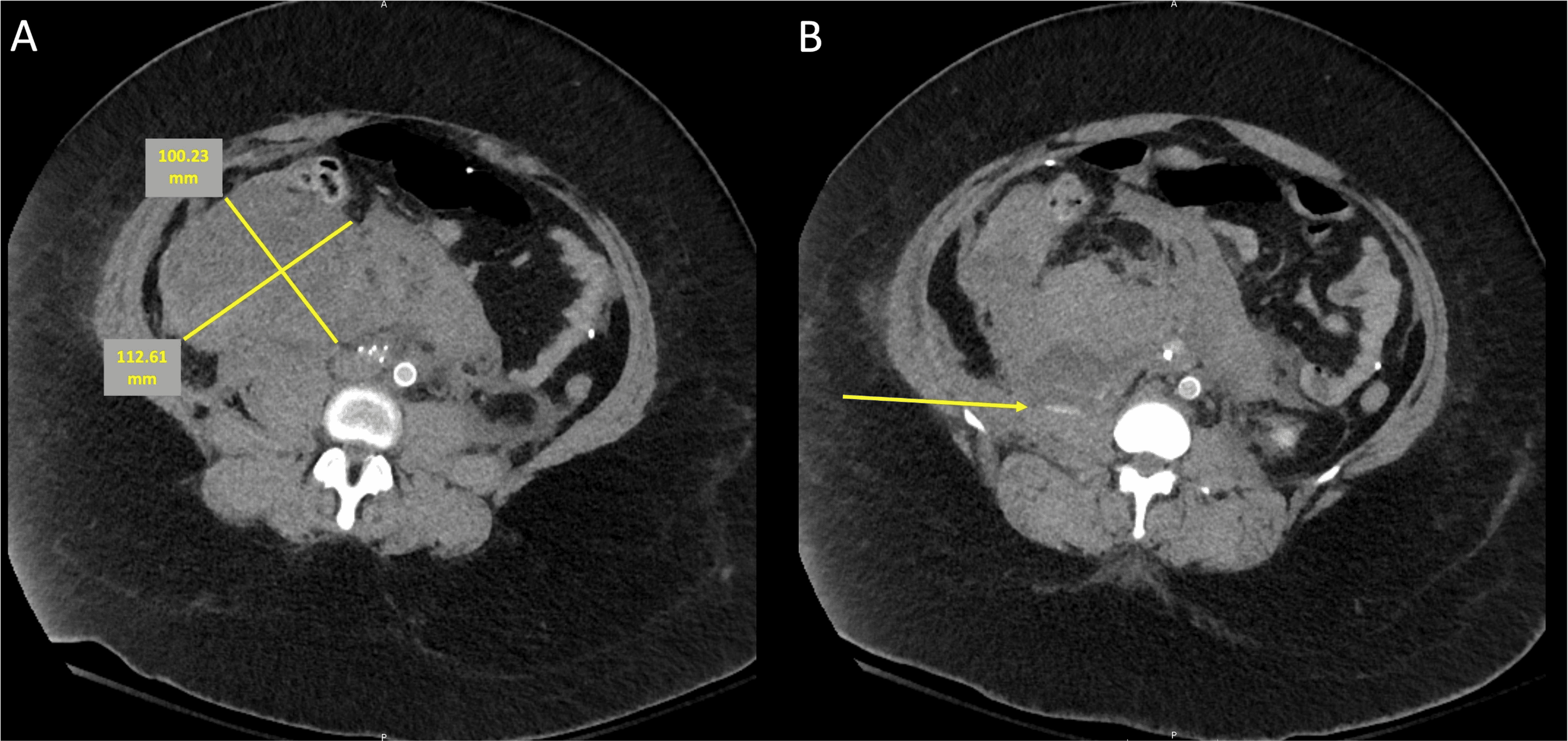 Delayed Arterial Hemorrhage From a Lumbar Artery Following Inferior ...