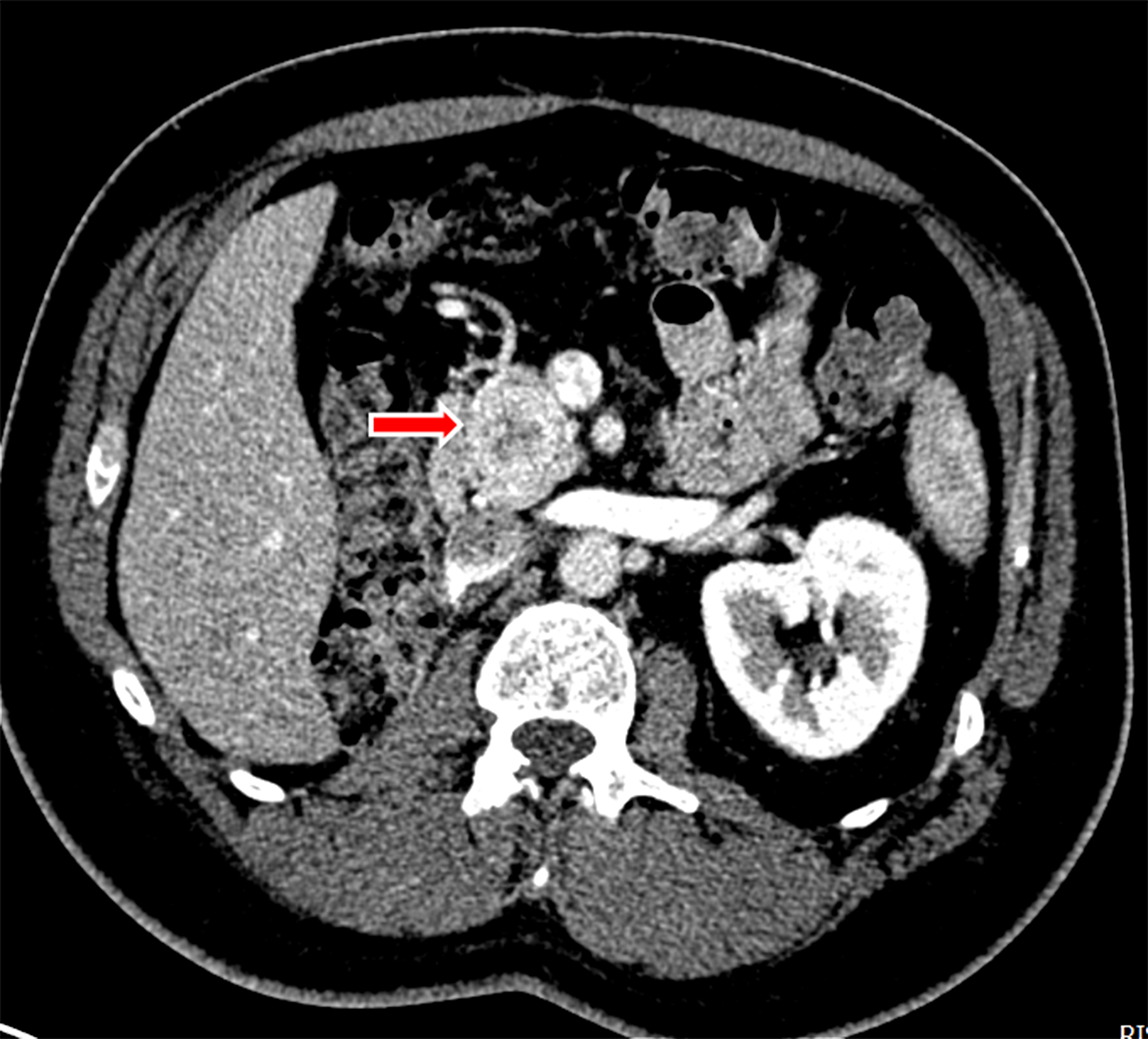 Cureus | CyberKnife Robotic Radiosurgery Of Three Pancreatic Metastases ...