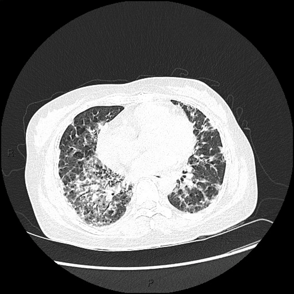 HRCT-of-patient-1-showing-ground-grass-opacities-in-bilateral-lung-bases