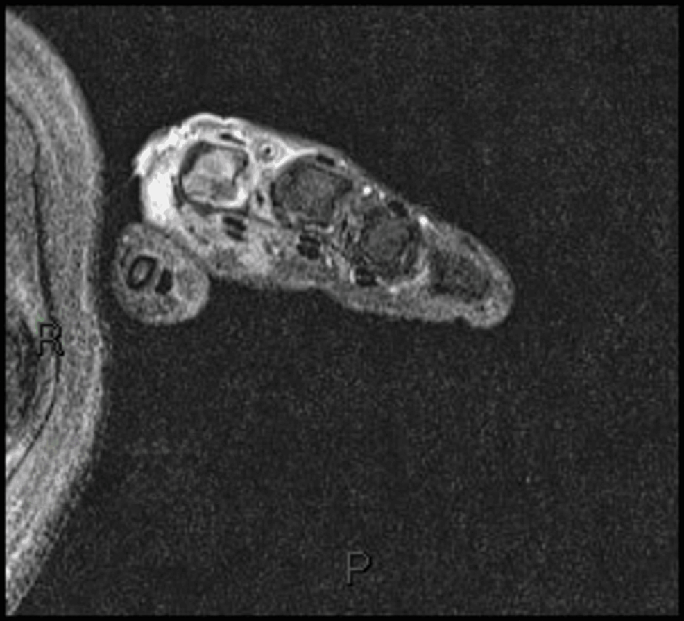 MRI-of-patient-1-showing-inflammatory-changes-to-the-right-MCP-joint-of-the-index-finger-with-associated-muscle-damage