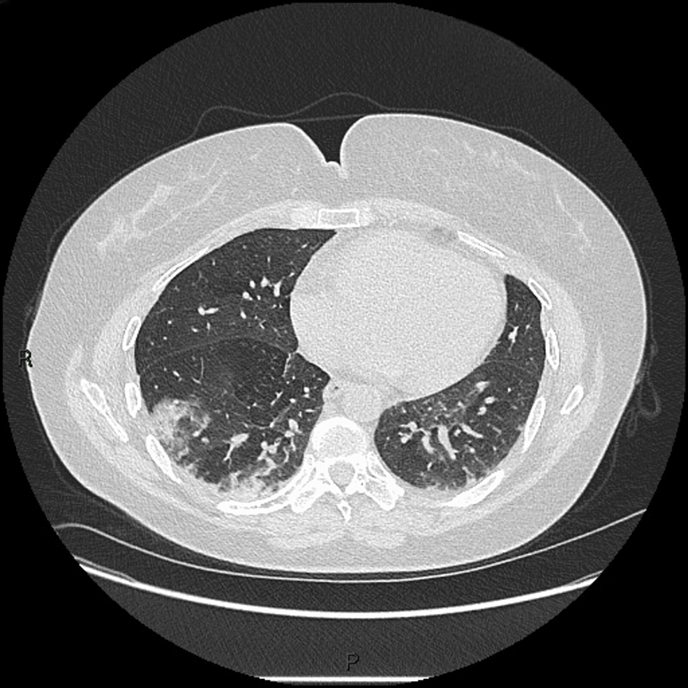 HRCT-of-patient-2-showing-right-middle-lobe-pneumonitis-and-ground-glass-opacities