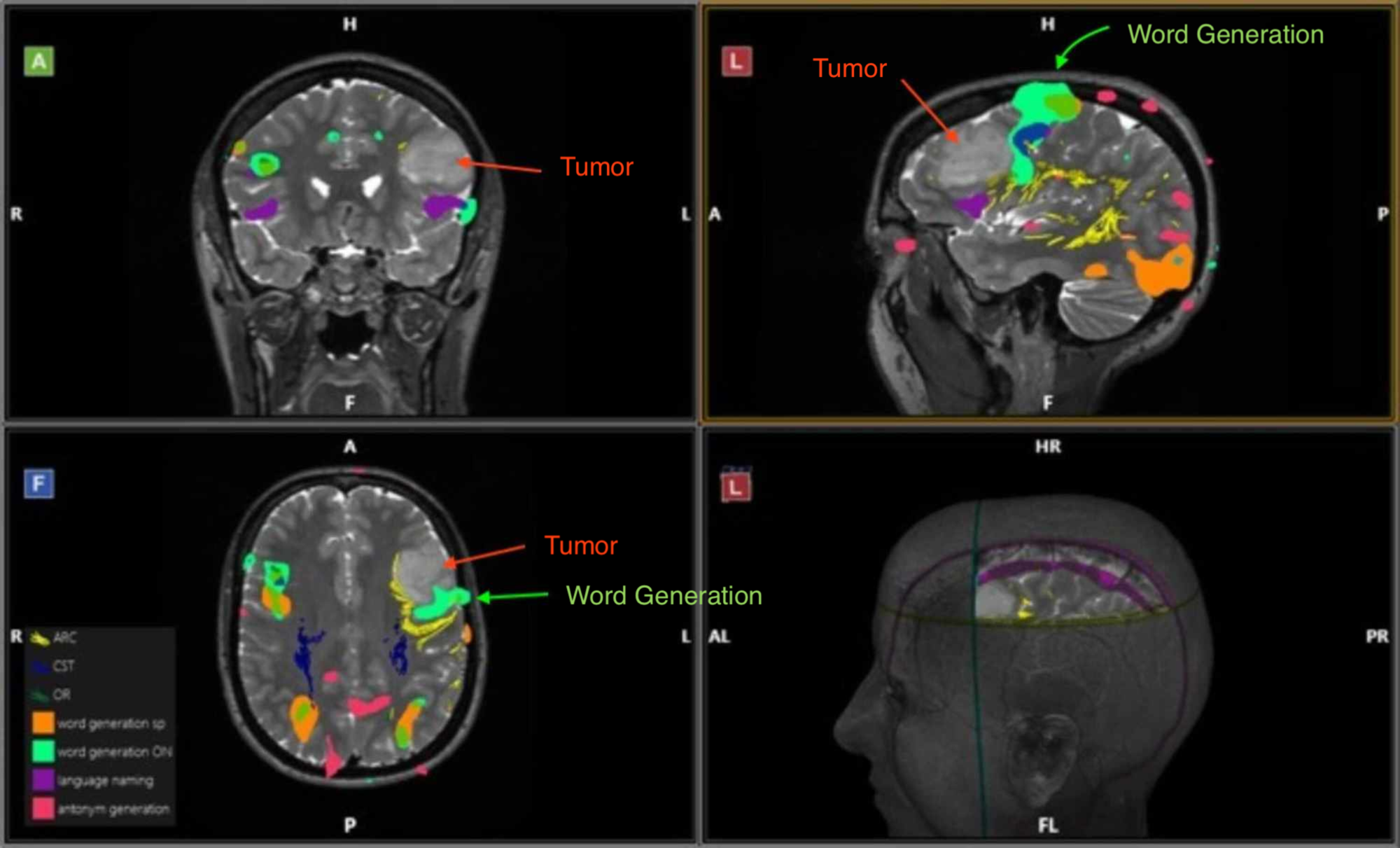 Cureus Reconciling Functional MRI Findings With Intraoperative Anatomy in Brain Tumor Surgery