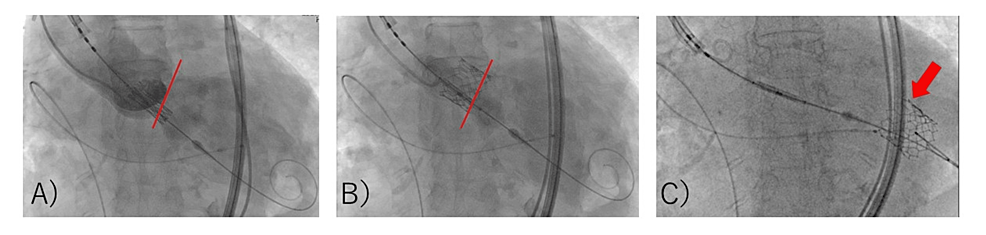 Fluoroscopic-images-of-the-first-TAVR-valve-implantation