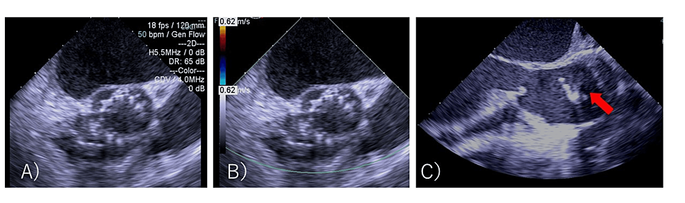 Transesophageal-echocardiographic-images-of-the-second-TAVR-valve