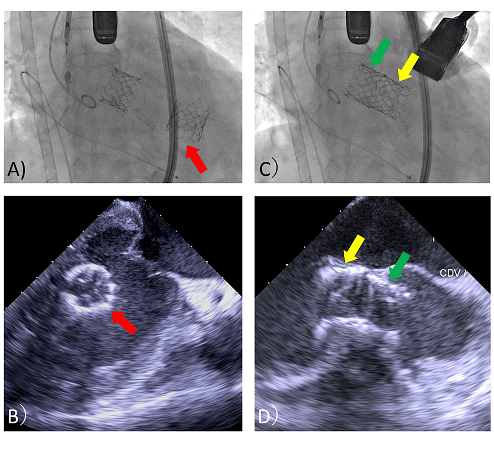 Fluoroscopic-and-TEE-images-of-the-migrated-first-TAVR-valve