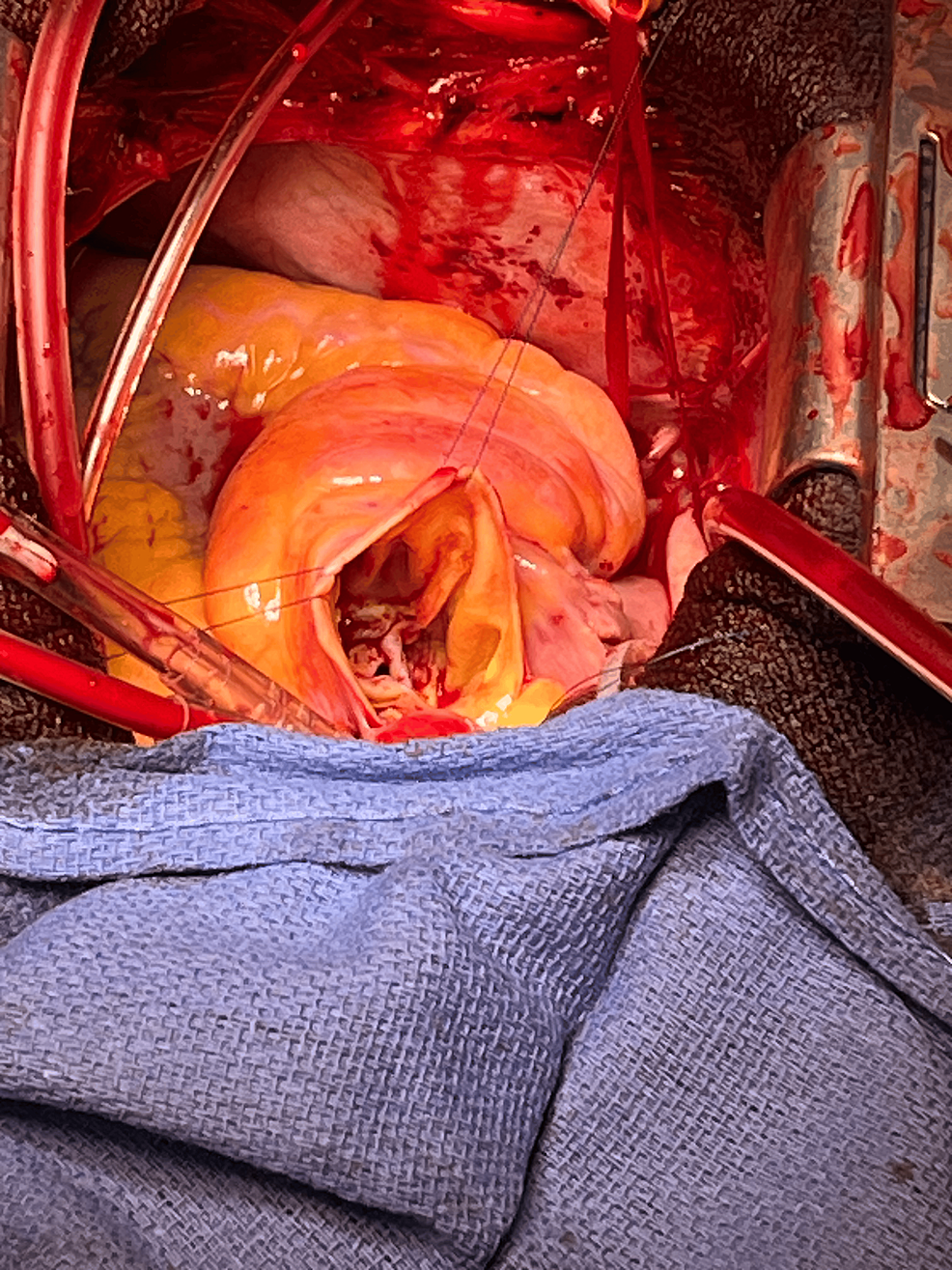 Intraoperative-view-of-the-patient’s-native-aortic-valve