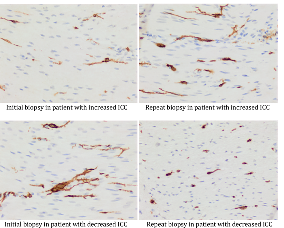 Interstitial-cells-of-Cajal-(ICC)-counts-in-full-thickness-biopsies