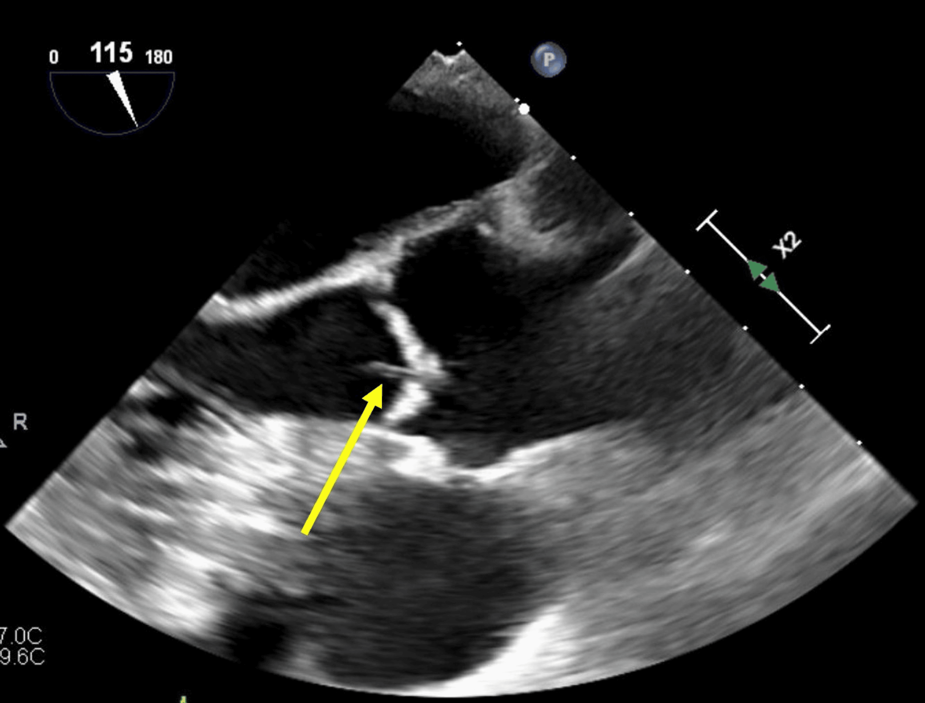 Lambl’s Excrescence and Management of Recurrent Cerebrovascular ...