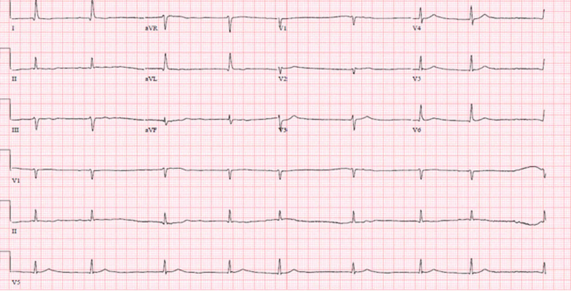 Cureus | Lithium-induced Cardiotoxicity: A Rare Clinical Entity