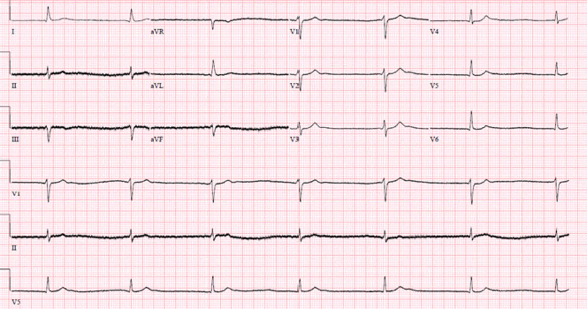 Cureus | Lithium-induced Cardiotoxicity: A Rare Clinical Entity