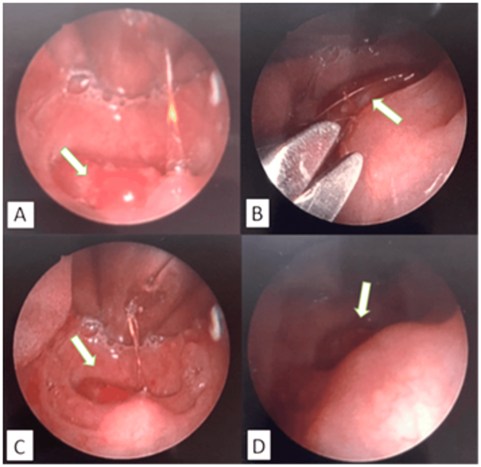 Cureus HairThread Tourniquet Syndrome A Comprehensive Review