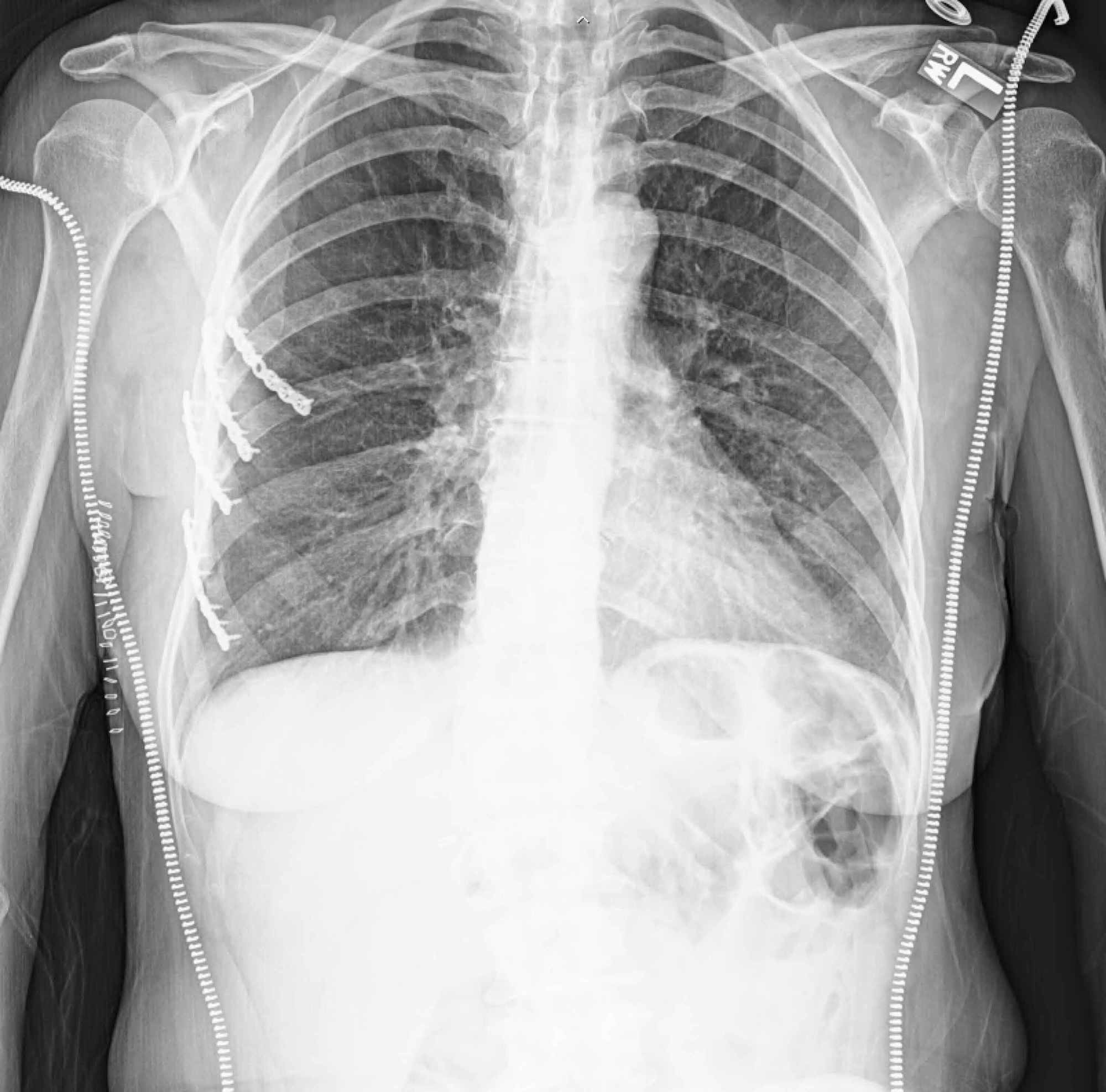 Subcutaneous Emphysema