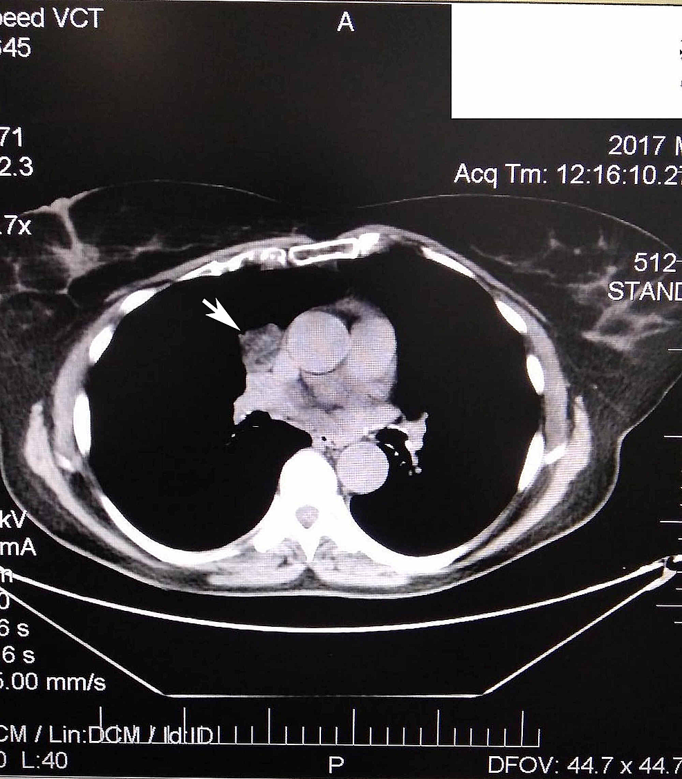 cureus-mediastinal-cartilaginous-hamartoma