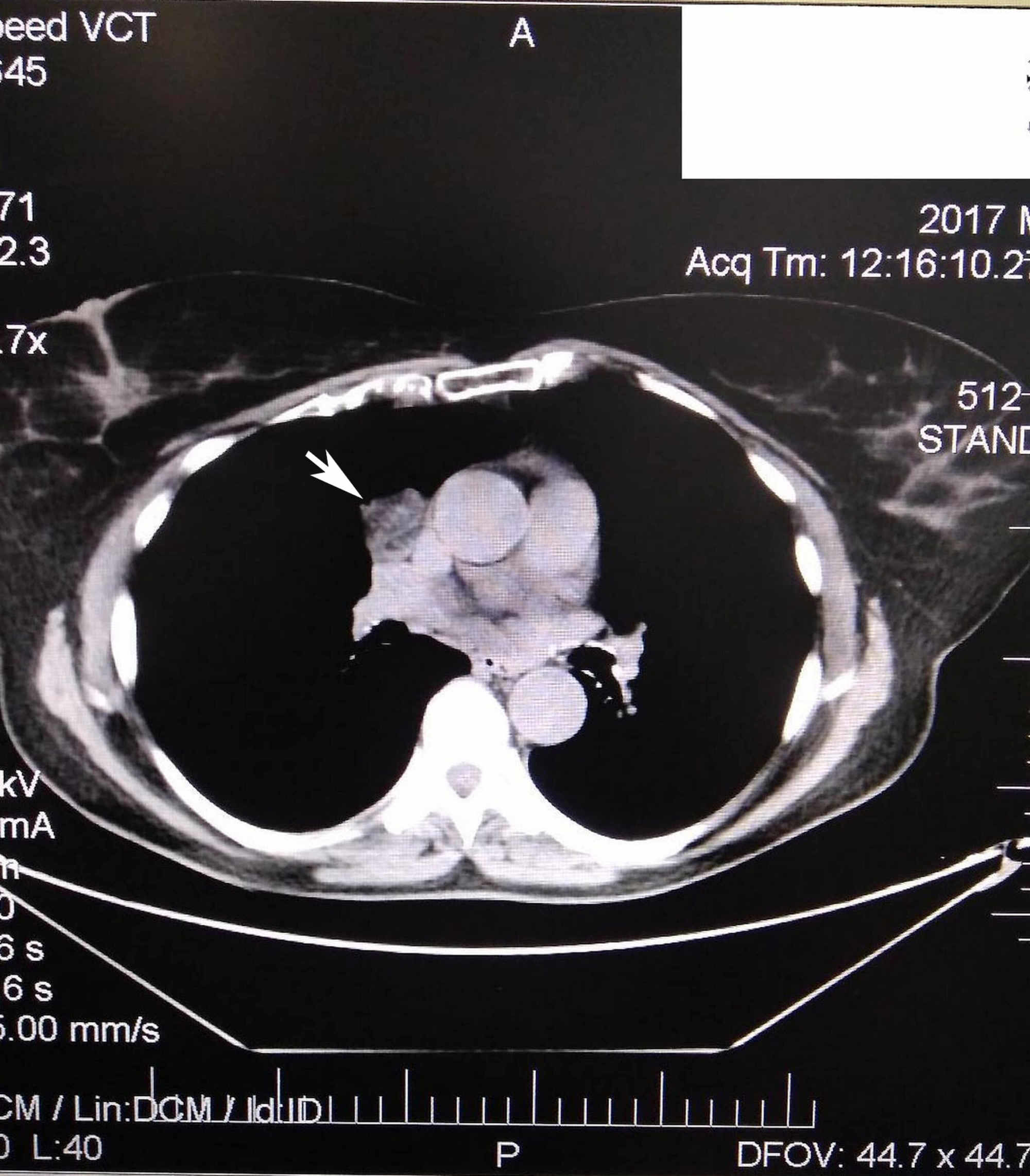 illustration-of-mediastinal-lymph-node-stations-and-abdominal-regions